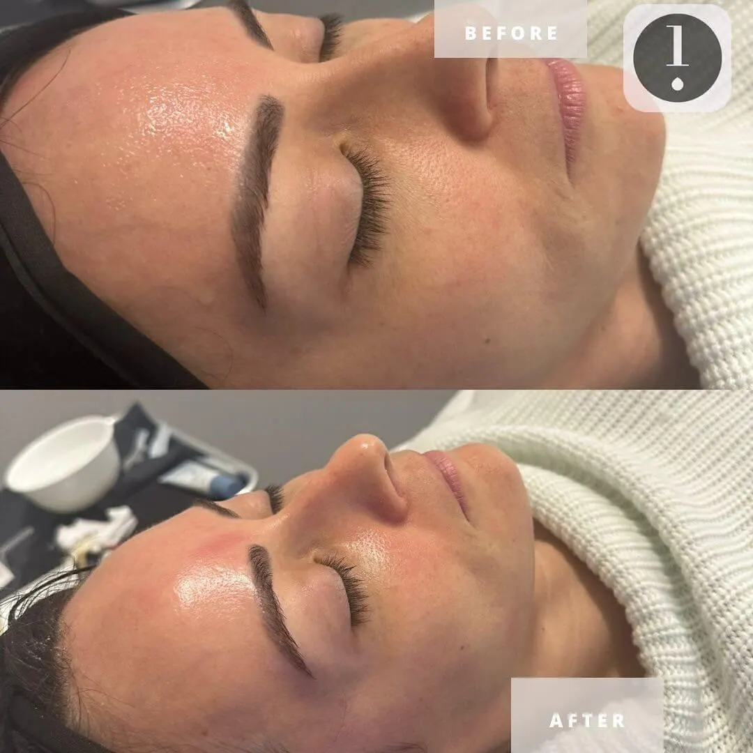 Treatment result