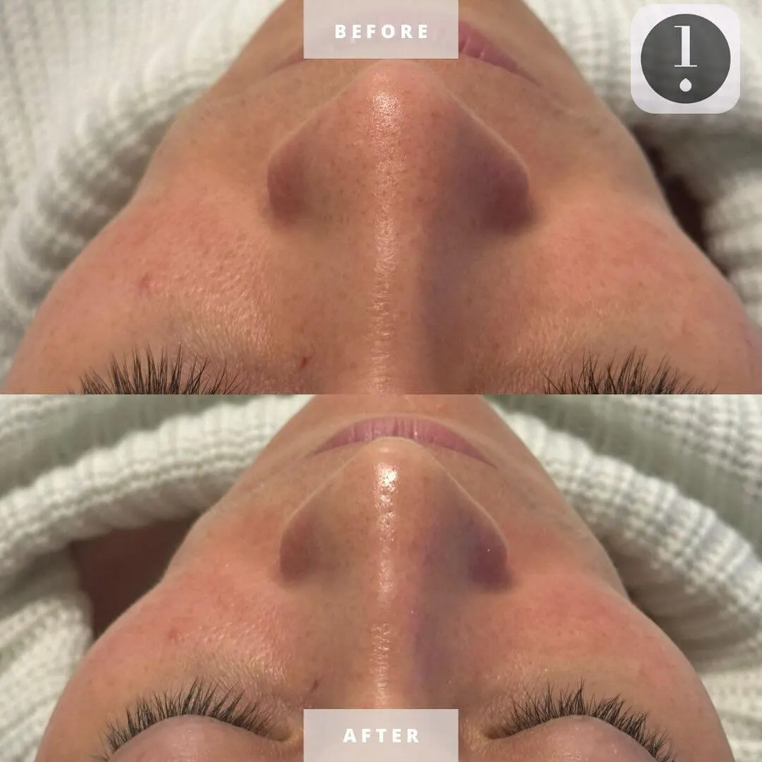 Treatment result